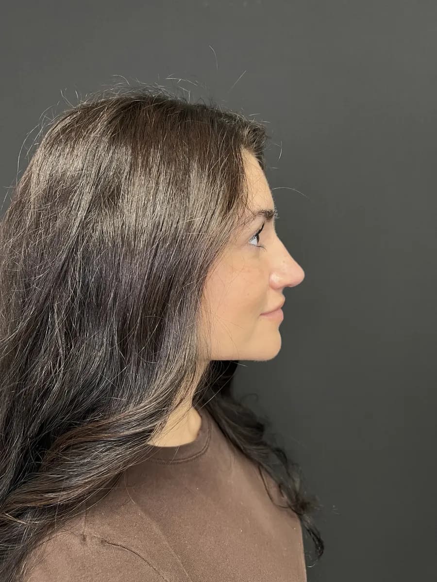 Rhinoplasty, after