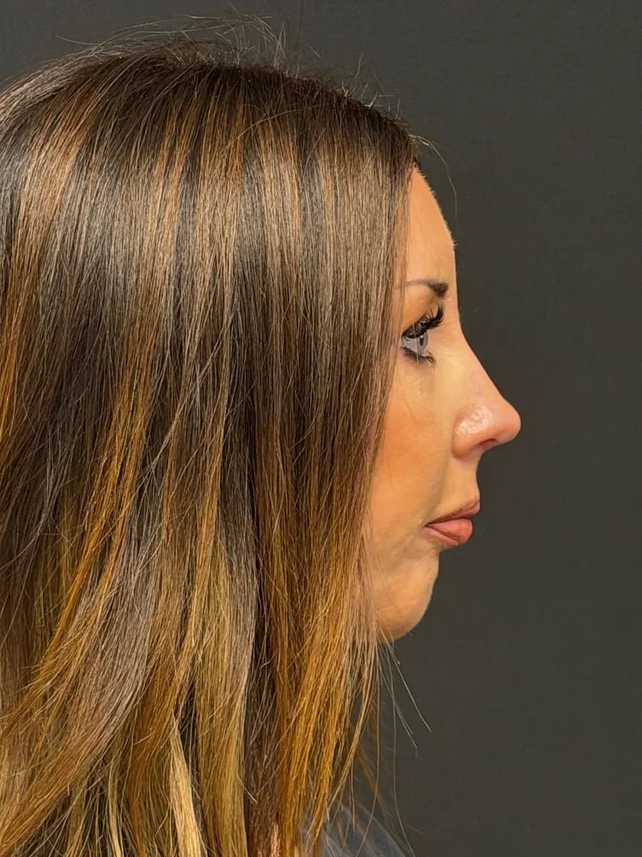 Rhinoplasty Plus Small Chin Augmentation Using Silicone Implant, after