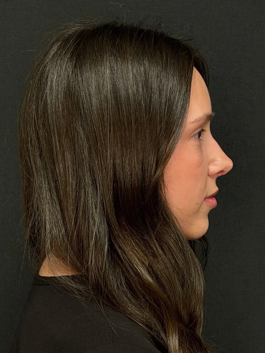 Rhinoplasty, after